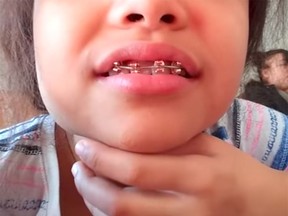 This screen grab of a YouTube video showing how to make fake braces is one of an increasing number of images and online videos on social media promoting the idea.