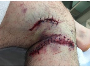 Randal Warnock received serious wounds to his legs when he was attacked by a grizzly bear on a B.C. beach. He bandaged himself up and called the coast guard for help.