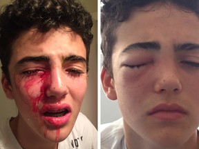 North Vancouver teen Matthys van Bylandt suffered a serious eye injury on Monday night when he was pelted in the face by an egg.