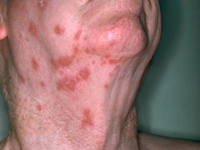 A view of a patient's neck reveals the presence of a rash attributed to shingles in a handout photo. THE CANADIAN PRESS/HO-National Institute of Allergy and Infectious Diseases **MANDATORY CREDIT**