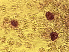 This photomicrograph reveals McCoy cell monolayers with Chlamydia trachomatis inclusion bodies; Magnified 200X. Chlamydia, caused by Chlamydia trachomatis, is the most common bacterial sexually transmitted infection. Using cell cultures from the McCoy cell line is one methods implemented in diagnosing Chlamydial infections.