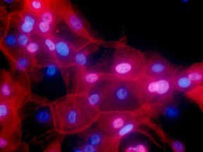 FILE - This undated fluorescence-colored microscope image made available by the National Institutes of Health in September 2016 shows a culture of human breast cancer cells. On Wednesday, Sept. 12, 2018, scientists reported they've found a new way to determine whether specific genetic abnormalities are likely to make people sick, a step toward avoiding a vexing uncertainty that can surround DNA test results.