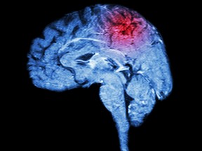 A Magnetic Resonance Imaging ( MRI ) of brain and stroke. (Getty Images)