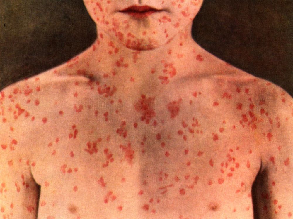  A symptom of measles includes a rash that starts on the torso and spreads to the limbs.