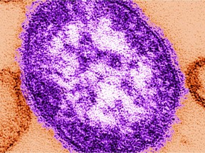 This undated image made available by the Centers for Disease Control and Prevention on Feb. 4, 2015 shows an electron microscope image of a measles virus particle.