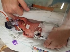 Sophy Davis's baby, Hugo, was born at 26 weeks and four days gestation on Sept. 23, 2018. He weighed 1,044 grams (a little over 2 lbs) and was delivered via emergency C-section at B.C. Women's Hospital + Health Centre. Her due date was Dec. 26, 2018. Photo: Courtesy of B.C. Women's Hospital.