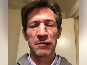 Colin Knowles says a stranger coughed deliberately in his face and then attacked him outside the Granville Street Skytrain station on Thursday. Knowles suffered a broken nose and lost a tooth in the assault.