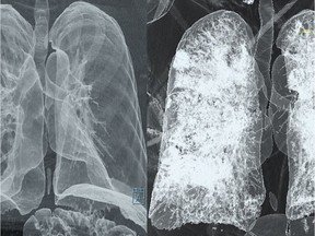 At left is a healthy lung that is clear. On the right is the lungs of a COVID-19 patient — white and hazy, like a white-out or blizzard.