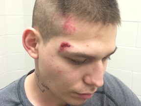 A photo showing injuries Cuyler Richard Aubichon allegedly received during his arrest in February, 2016 by Prince George RCMP.
