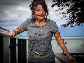 Stasi Manser survived burns to 95 per cent of her body when she was five years old and waited more than 40 years to connect with other burn survivors. She now volunteers with the B.C. Professional Firefighters Burn Fund, helping to lead sharing circles for others who are reluctant to reach out or unaware of the peer support it offers. Photo: Dave Harcus