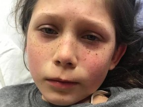 A 10-year-old girl reportedly suffering from MIS-C, a rare syndrome associated with COVID-19. The girl's mother released the picture through a Facebook group to warn parents to watch for symptoms in their children.