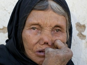 With modern antibiotics, advanced cases of leprosy like this are increasingly rare, but 300,000 people a year still get the bacterial disease.