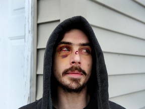 Alex Fisher says he was beaten by the Surrey RCMP after being mistaken for a robbery suspect.
