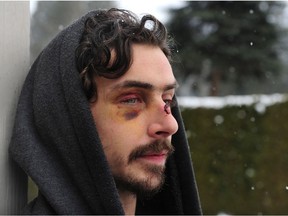 Alex Fisher, who says he was beaten by the Surrey RCMP after being mistaken for a robbery suspect, has his photo taken in Surrey on Sunday.