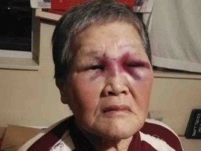 Xiao Zhen Xie suffered two black eyes and a swollen wrist after she was attacked by a man on a San Francisco street, Wednesday, March 17, 2021.