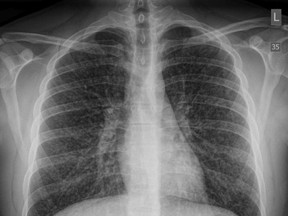 A chest x-ray of a 17-year-old boy two days after he was admitted to hospital with a severe lung illness doctors say is linked to his daily use of e-cigarettes.