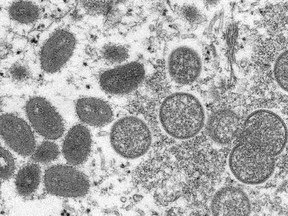 This undated electron microscopic (EM) handout image provided by the Centers for Disease Control and Prevention depicts a monkeypox virion, obtained from a clinical sample associated with the 2003 prairie dog outbreak. - It was a thin section image from a human skin sample. On the left were mature, oval-shaped virus particles, and on the right were the crescents, and spherical particles of immature virions. (Photo by Cynthia S. Goldsmith / Centers for Disease Control and Prevention / AFP) / RESTRICTED TO EDITORIAL USE - MANDATORY CREDIT "AFP PHOTO / Cynthia S. Goldsmith / Centers for Disease Control and Prevention " - NO MARKETING - NO ADVERTISING CAMPAIGNS - DISTRIBUTED AS A SERVICE TO CLIENTS