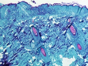 An electron microscopic (EM) image shows mature, oval-shaped monkeypox virus particles obtained from a human skin sample.