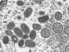 An electron microscopic (EM) image shows mature, oval-shaped monkeypox virus particles obtained from a human skin sample.
