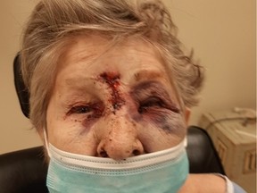 Joyce Robinson suffered a broken nose, fractured orbital bone and torn eye duct from a fall. ‘My mom has been through ER many, many times. They usually keep her for several days to assess. This is truly a first,’ says Sandra Robinson.