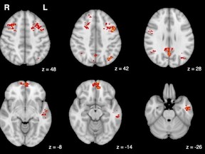fMRI showing decreased functional connectivity in the brain following exposure to traffic pollution.