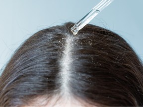 Dandruff scalp
