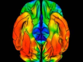 Brain scans of a man from Colombia show limited buildup of tau protein in his entorhinal cortex, a region that is characteristically affected in the early clinical stages of Alzheimer’s disease. (Yakeel T. Quiroz, Justin Sanchez/Massachusetts General Hospital)