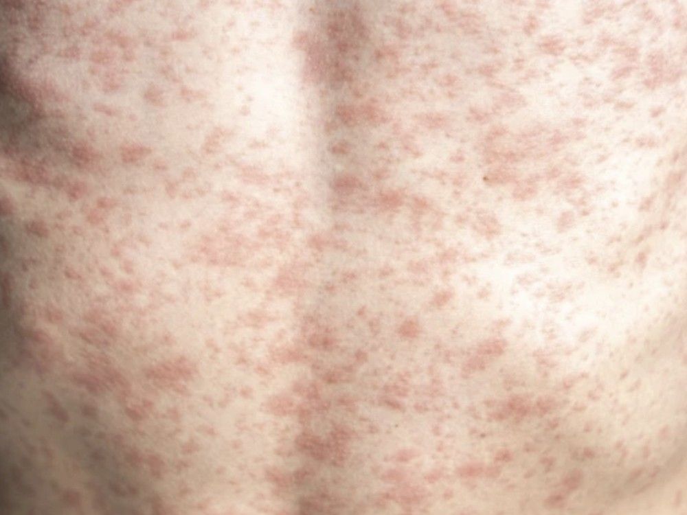 A person's body is covered in a rash, measles.