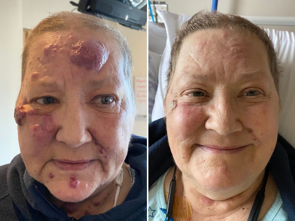 This is a before and after photograph of Beverly Henry, 62, who was diagnosed in November 2024 with acute myeloid leukemia, a rare and fast-moving cancer that was spreading rapidly through her body. The cancer failed to respond to three rounds of chemo and Henry was told she had just weeks, maybe days, to live. But on March 13 she became the first patient in B.C. to be treated with a new drug that targets her specific leukemia subtype. She's now living life, home and happy, while continuing to be treated. This is a before and after photograph of Beverly Henry, 62, who was diagnosed in November 2024 with acute myeloid leukemia, a rare and fast-moving cancer that was spreading rapidly through her body. The cancer failed to respond to three rounds of chemo and Henry was told she had just weeks, maybe days, to live. But on March 13 she became the first patient in B.C. to be treated with a new drug that targets her specific leukemia subtype. She's now living life, home and happy, while continuing to be treated.