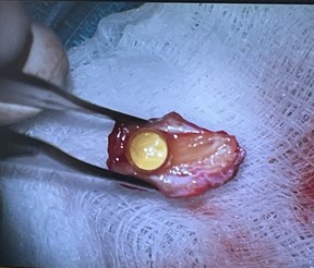 Gail Lane’s tooth, with a lens inserted inside, after it was cut out of her cheek where it had been embedded for three months. Source: Ann Gibbon, Providence Health Care
