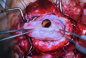 Gail Lane’s tooth, with a lens inserted inside, being stitched over her eye. Source: Ann Gibbon, Providence Health Care