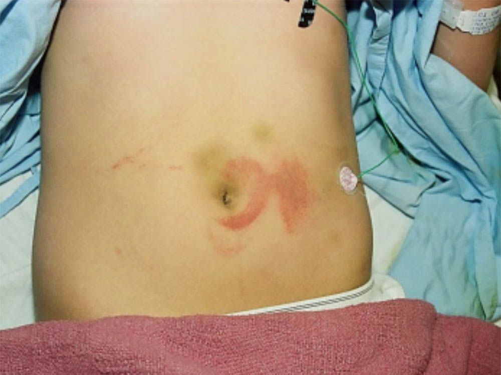  Abdominal injuries to A.Q., the plaintiff in a lawsuit against a Vancouver Buddhist temple and its spiritual leader for alleged physical, sexual and psychological abuse while living under the temple’s care from 2006 to 2009.