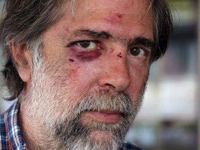 Allen Lucier, 55,  shown after a road rage incident where he and a 82-year-old friend were beaten and Windsor Police were called, Wednesday Aug. 22, 2012.  (NICK BRANCACCIO/The Windsor Star)