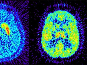 A brain is seen in this PET scan image. (Centre for Addiction and Mental Health. )