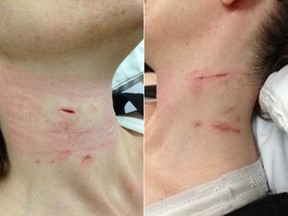 The right and left sides of Dawn Hepp's neck after a wolf clamped its jaws down. These photos were taken soon after the bite.(Courtesy of Dawn Hepp)