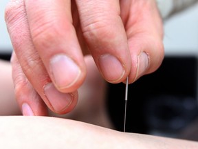 Sue Salsbury receives acupuncture on her Achilles tendon in this 2011 file photo.    (Brian J. Gavriloff / Edmonton Journal)