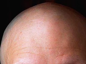 Baldness before age 60 was connected with more advanced cancers in younger men. (Postmedia News files)