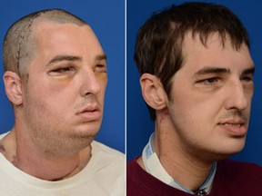 In a series of four photos provided by the University of Maryland Medical Center and a June 18, 2013 Associated Press photo, face transplant recipient Richard Norris, the recipient of the most extensive face transplant performed to date, is seen in a prom photo, from left to right, a photo taken before his face transplant, a photo made six days after the transplant and a photo made 114 days after the transplant. Norris received the transplant in a 36-hour operation in March 2012. It included the replacement of both jaws, teeth, tongue, and skin and underlying nerve and muscle tissue from scalp to neck. Norris was injured in a gun accident in 1997. (AP Photo/University of Maryland Medical Center and Pat Semansky)