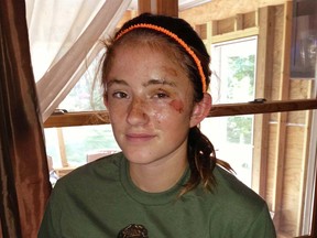Abby Wetherell, 12, at her home in Cadillac, Mich. Abby was mauled by a black bear in northern Michigan last week said Monday she feared for her life during the attack. She was released from a hospital Sunday where 100 stitches were needed to close wounds on her left thigh and back, and is walking on crutches. She says she’s still in pain but expects to be fine. (AP Photo/Rob Hess)