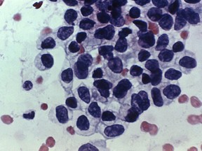 File photo of a photomicrograph showing cancerous cells detected by a Pap test. (Handout)