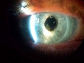 Recurrent corneal erosion (RCE) occurs when the outer layer of the cornea, known as the epithelium, loosens or peels off. The eye becomes very painful since the cornea is very sensitive to any disruption of cells. (JASON KRYK/The Windsor Star)