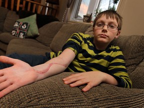 Cameron Chevalier shows off the scars on his arm from a snake bite he received back in September at his home in LaSalle on Tuesday, December 10, 2013. Chevalier was bitten by a Eastern Massasauga Rattlesnake but hospital staff didn't consider the snake while treating him. A simple blood test would have shown the venom.                  (TYLER BROWNBRIDGE/The Windsor Star)