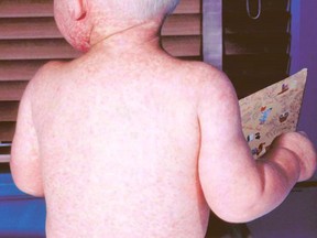 A child with measles is shown in this undated handout photo. 
(The U.S. Centers for Disease Control and Prevention)
