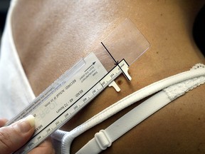 A doctor measures a mole on the back of a patient during a skin analysis. (NICK BRANCACCIO / Windsor Star files)