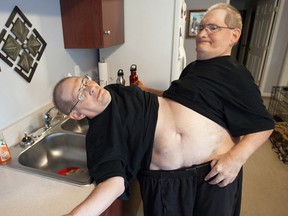 Donnie, left, and Ronnie Galyon sit inside their Beavercreek, Ohio, home, Wednesday, July 2, 2014. Donnie and Ronnie are nearing the record for longest living conjoined twins. The Galyons, born Oct. 28, 1951 at St. Elizabeth Hospital in Dayton, now live in Beavercreek with their brother, Jim Galyon and his wife Mary, who provide 24-7 care for them. (AP Photo/The Daily News, Drew Simon)
