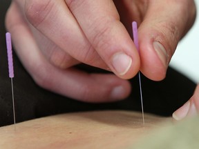 Acupuncture can help with a number of health issues, including stress relief and providing an energy boost for cancer patients. (DAN JANISSE / Windsor Star files)