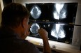 A radiologist checks mammograms in Los Angeles, in this May 2010 photo. Drs. Oz and Roizen recommend women should get regular mammograms in their 50s and beyond.  (Damian Dovarganes / Associated Press files)