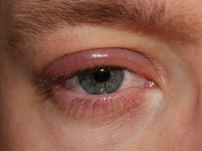 Blepharitis is a common condition which causes inflammation of the eyelids. It is a chronic external eye disorder resulting in red, burning and irritated eyes.