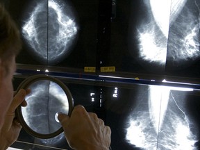 In this Thursday, May 6, 2010 file photo, a radiologist uses a magnifying glass to check mammograms for breast cancer in Los Angeles. Photograph by: Damian Dovarganes, File, AP Photo