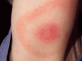 A rash in the pattern of a bulls-eye, which formed after a tick bite on this Maryland woman's right upper arm, who subsequently contracted Lyme disease, is shown in a photo released by the (U.S.) Centers for Disease Control and Prevention.
